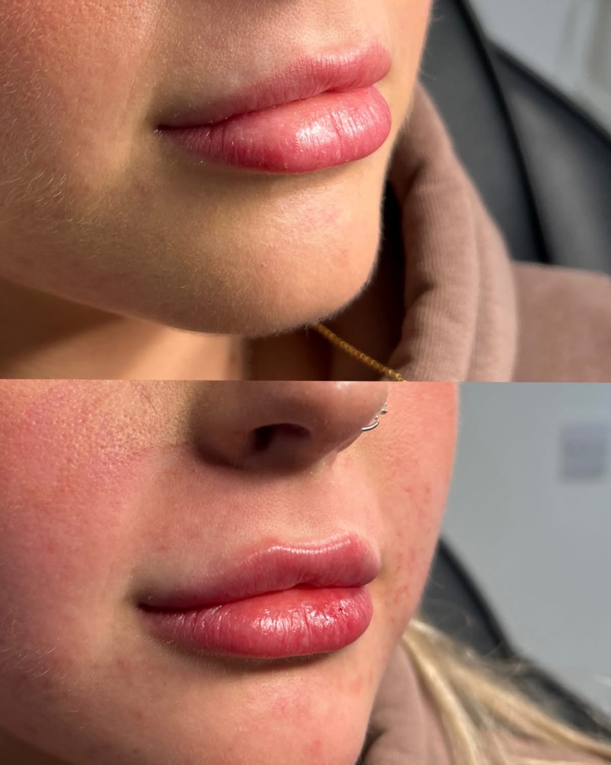 Lip enhancement before and after treatment