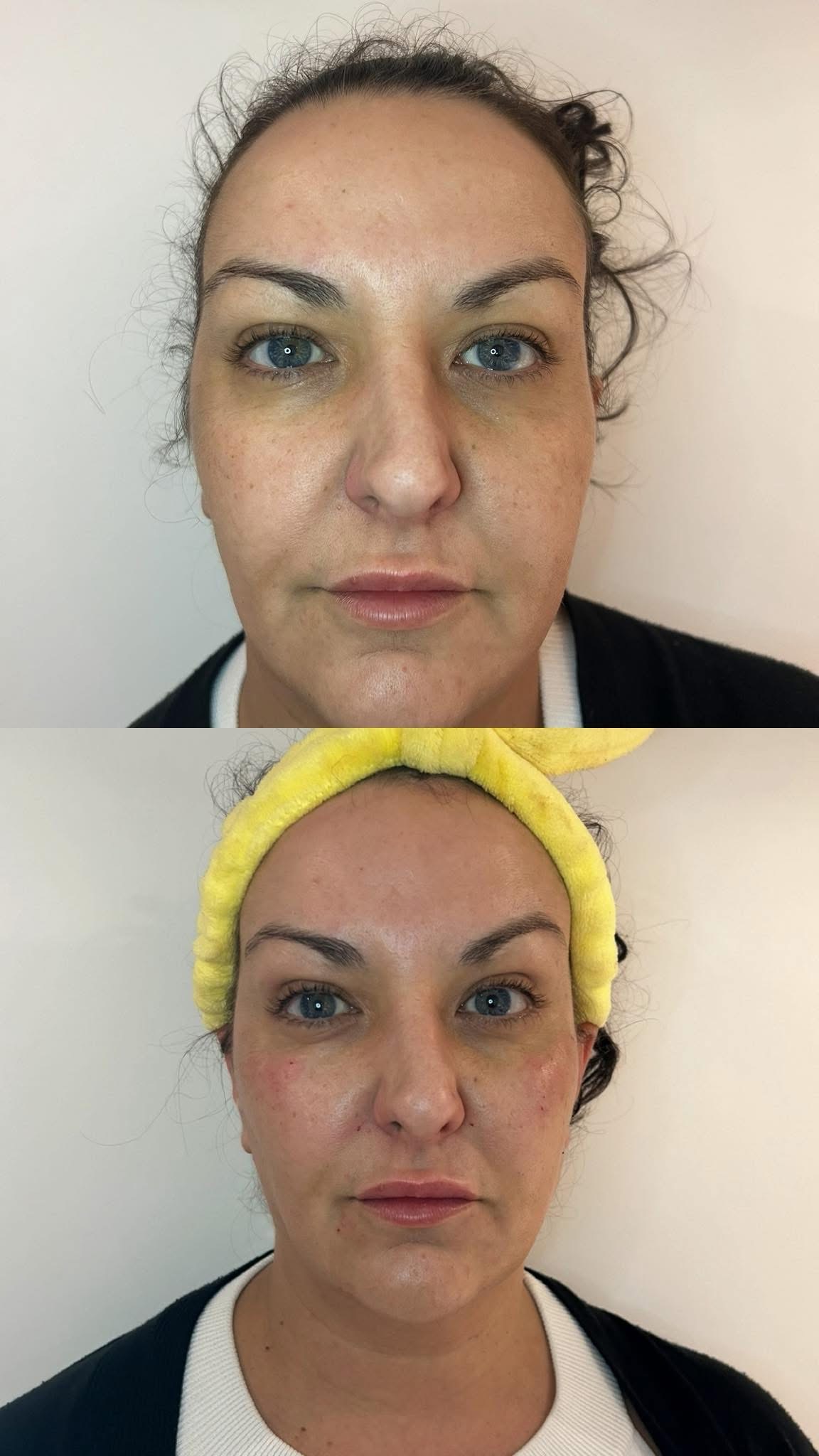 Before and after skin treatment result