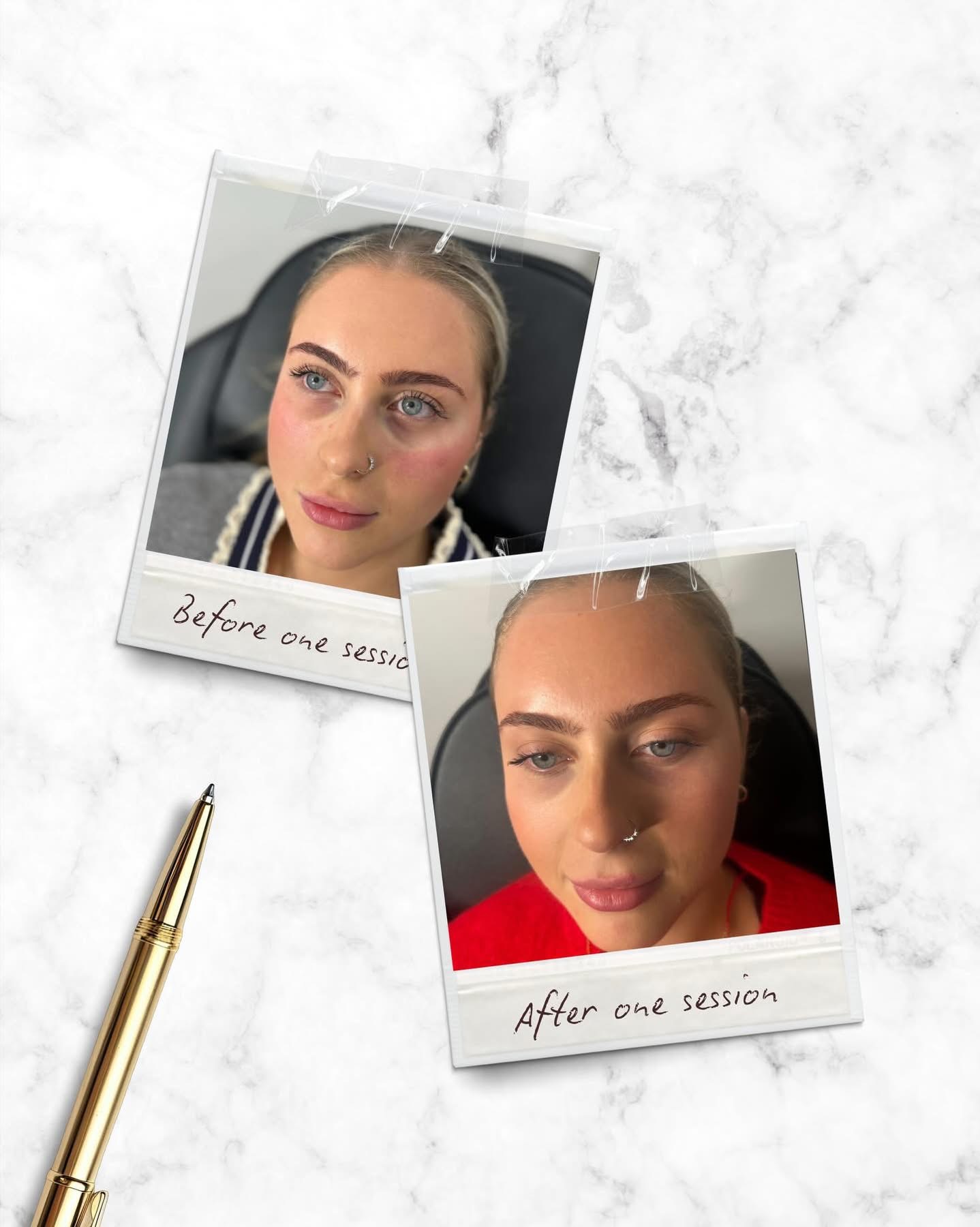 Polaroid style before and after treatment image